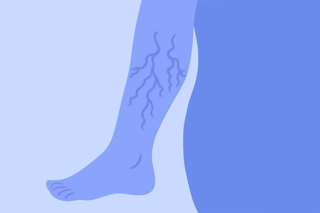 하지정맥류 내용 포스팅